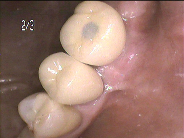 インプラント治療後　55_5