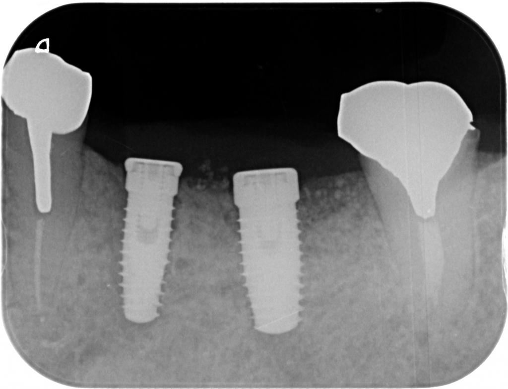 インプラント治療中　56_4