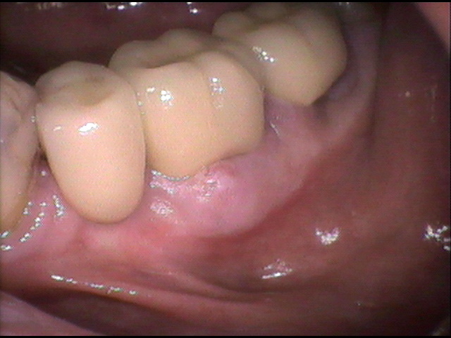 インプラント治療前　61_1