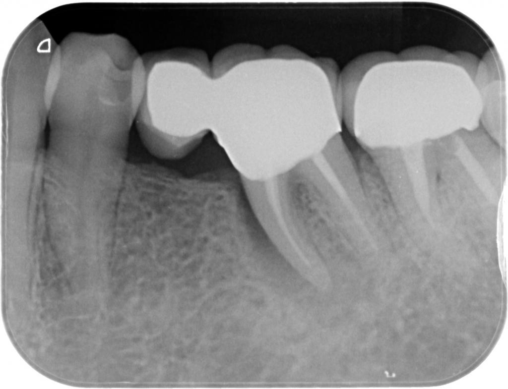 インプラント治療前 61_2