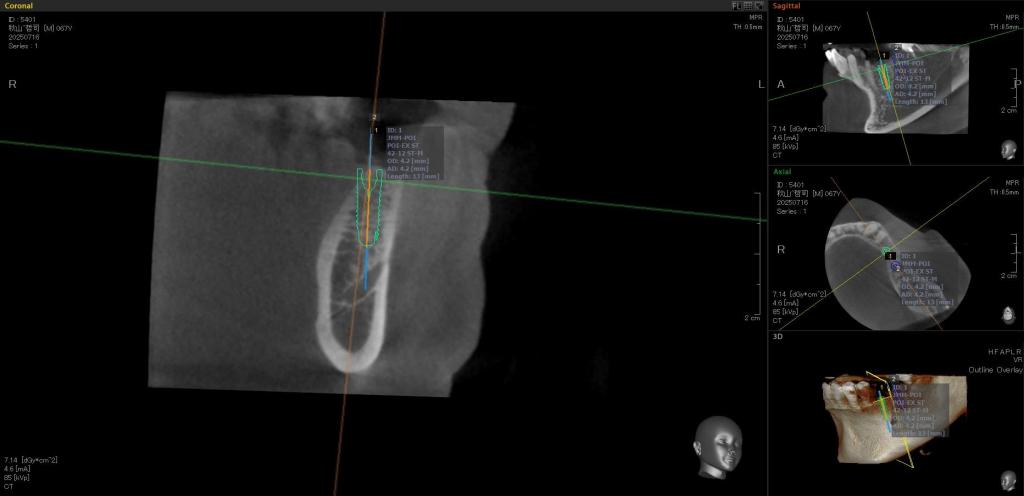 インプラント治療中 61_3