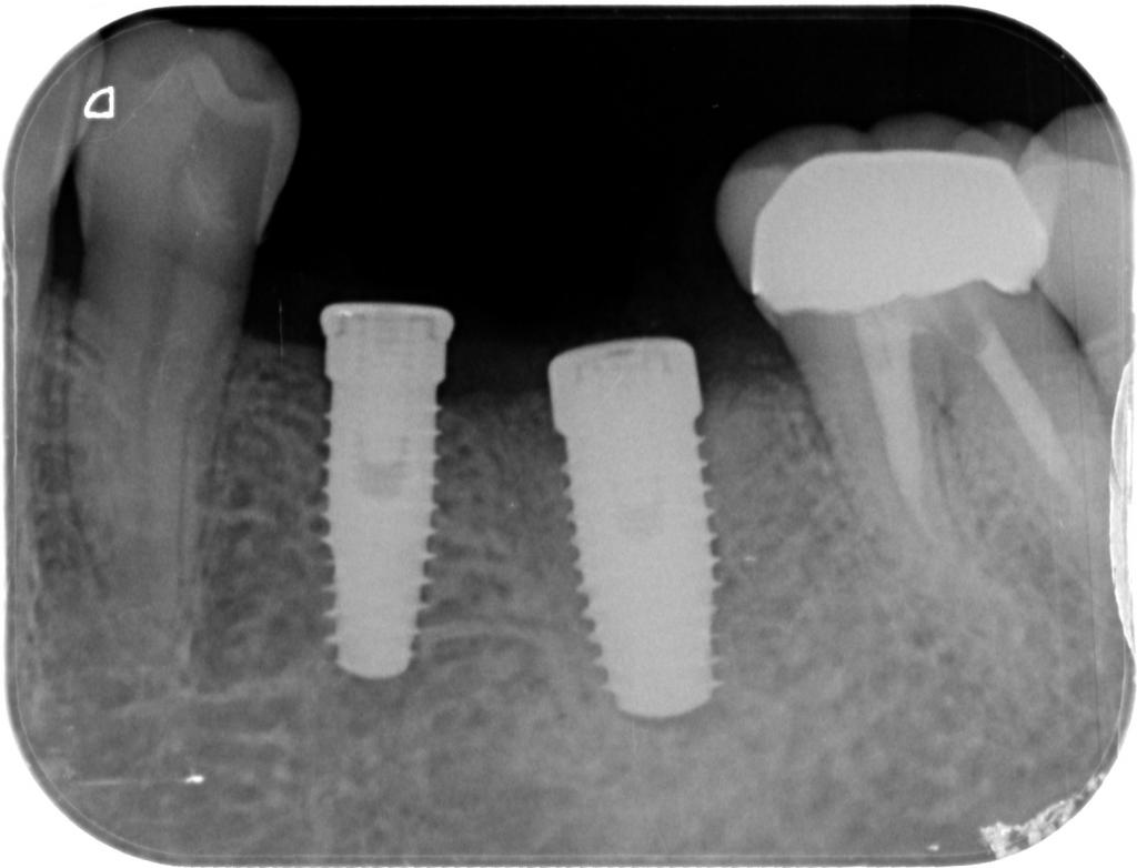 インプラント治療中 61_4