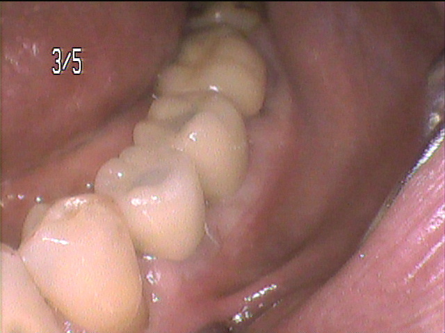 インプラント治療後 61_5