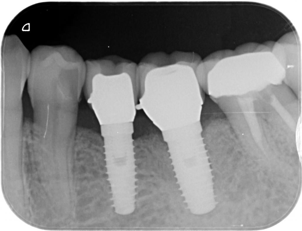 インプラント治療後 61_6