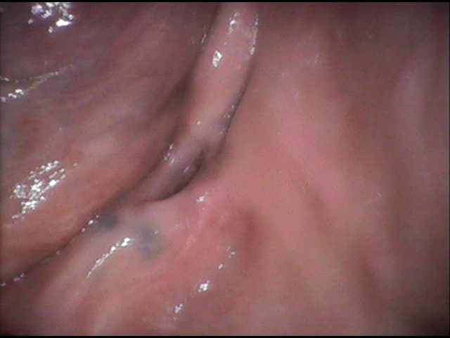 インプラント治療前　62_1