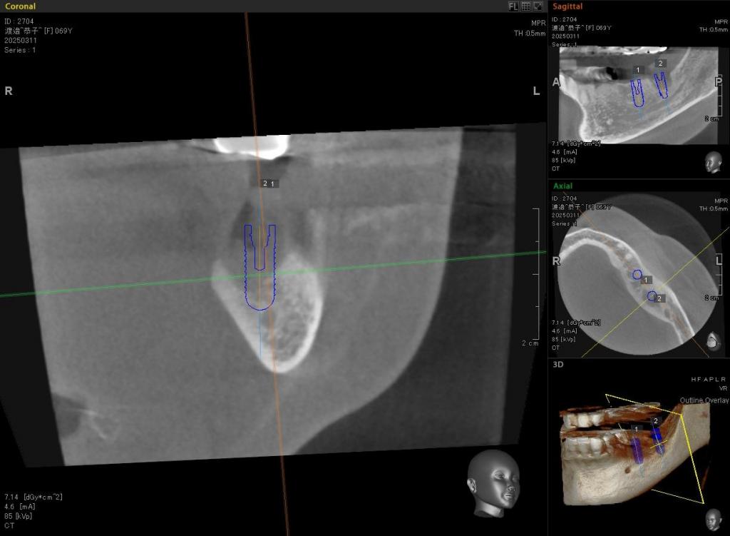インプラント治療中 62_3