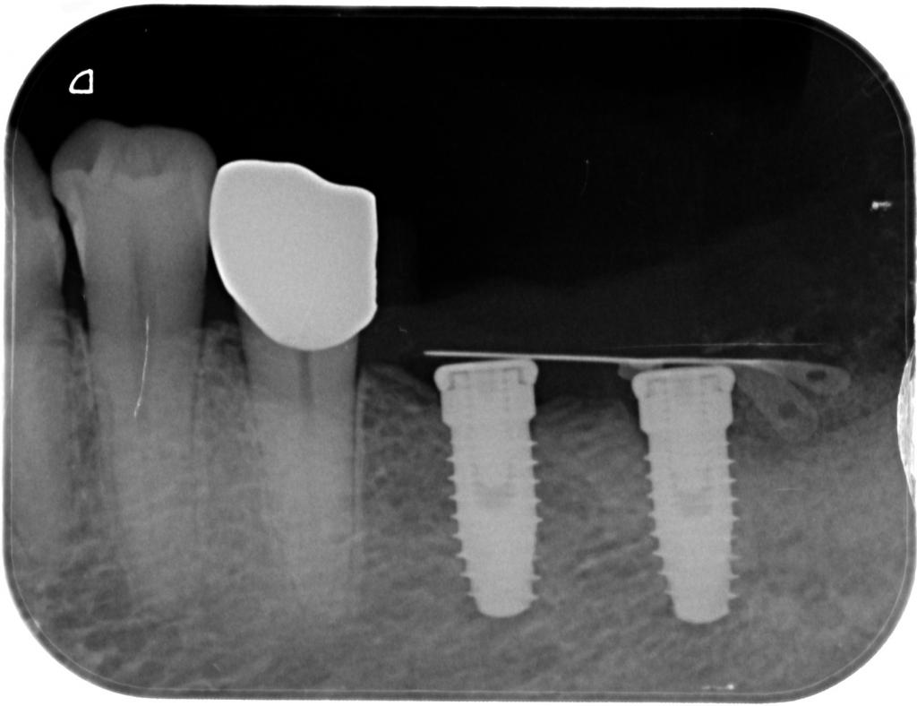 インプラント治療中 62_4