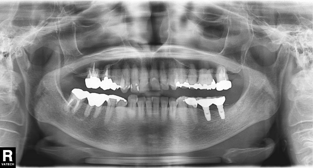 インプラント治療後 62_6