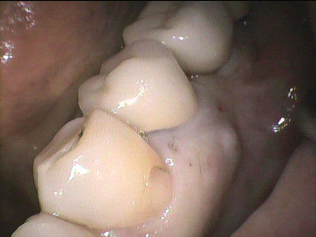 インプラント治療前 63_1