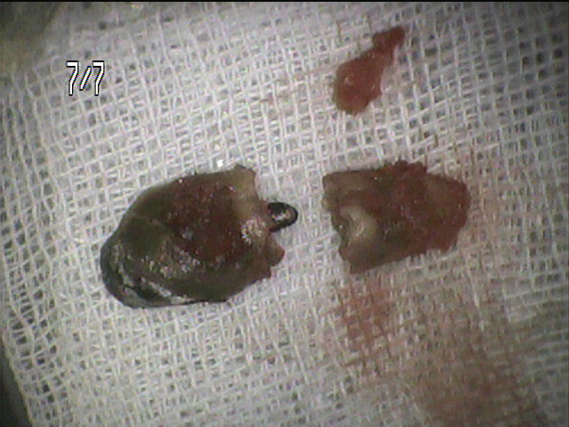 インプラント治療前 63_2