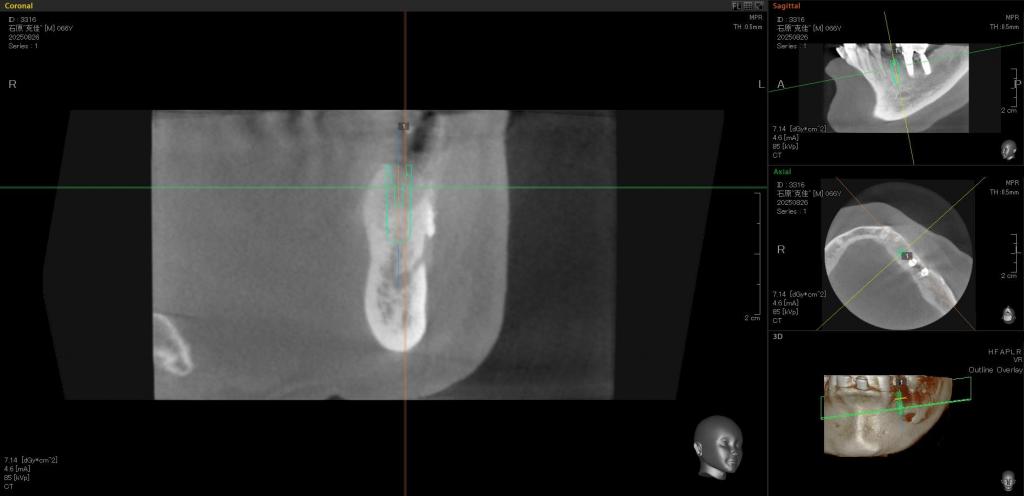 インプラント治療中 63_3