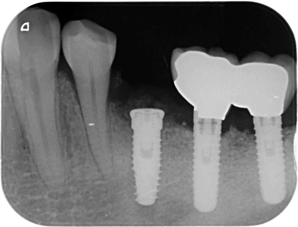 インプラント治療中 63_4