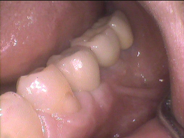 インプラント治療後 63_5