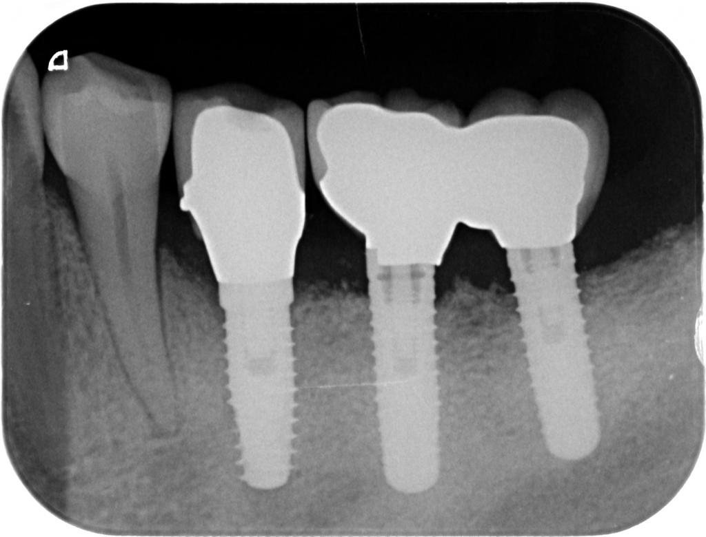 インプラント治療後 63_6