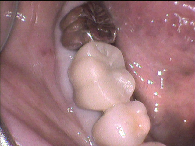 インプラント治療前　64_1