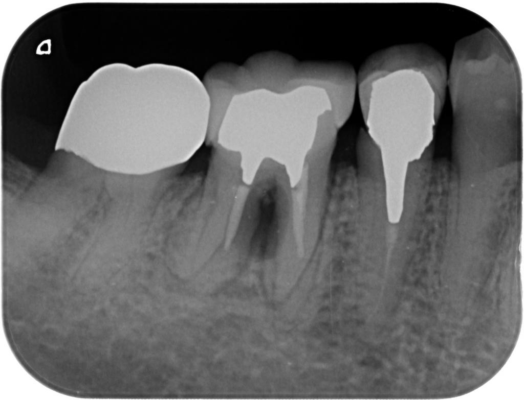 インプラント治療前　64_2