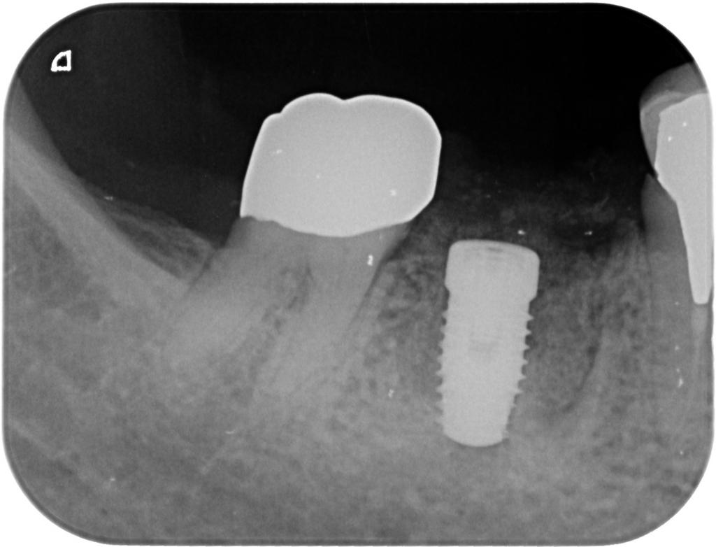 インプラント治療中　64_4
