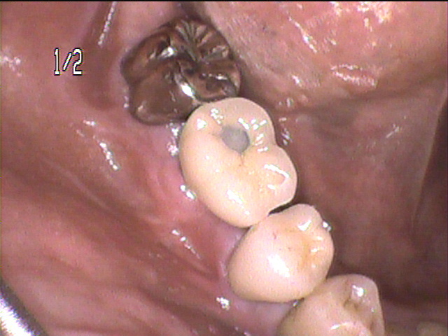 インプラント治療後　64_5