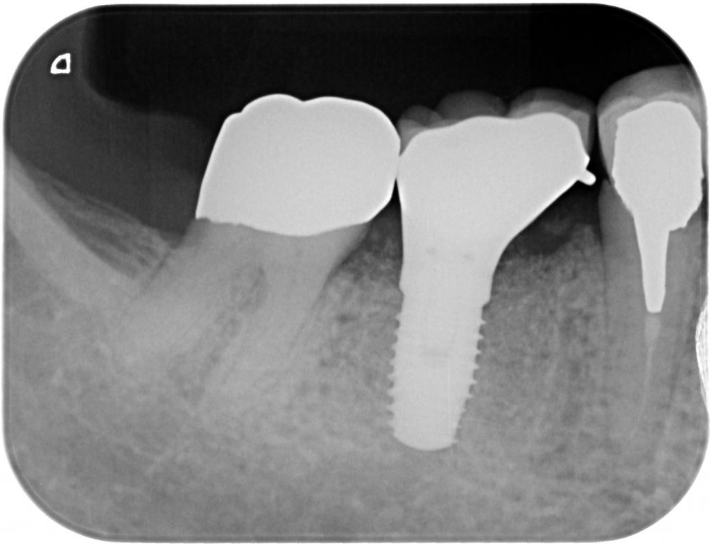 インプラント治療後　64_6