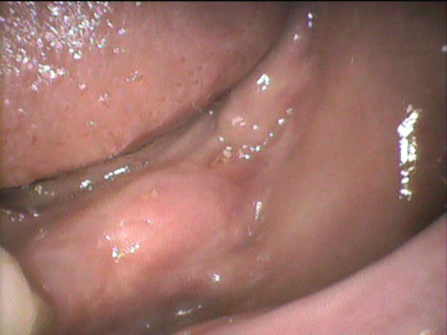 インプラント治療前　65_1