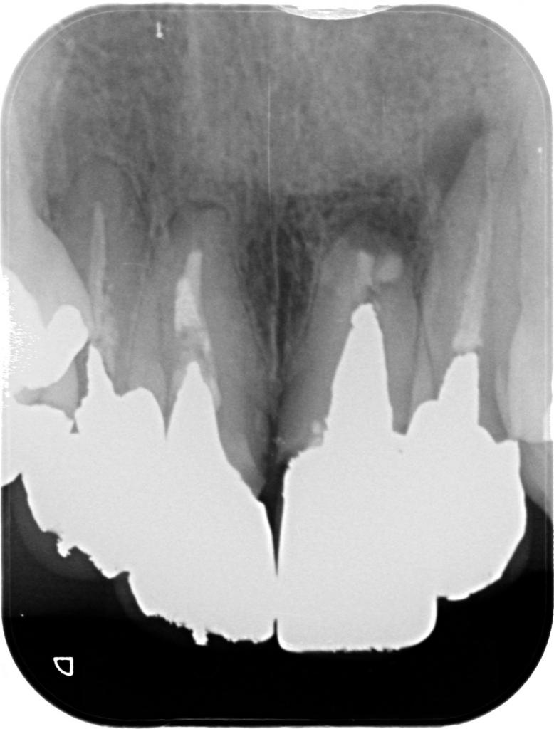 根管治療前　31_2