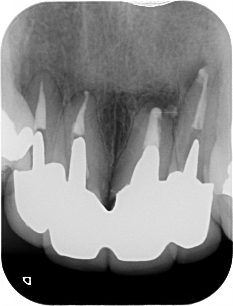 根管治療後　31_6