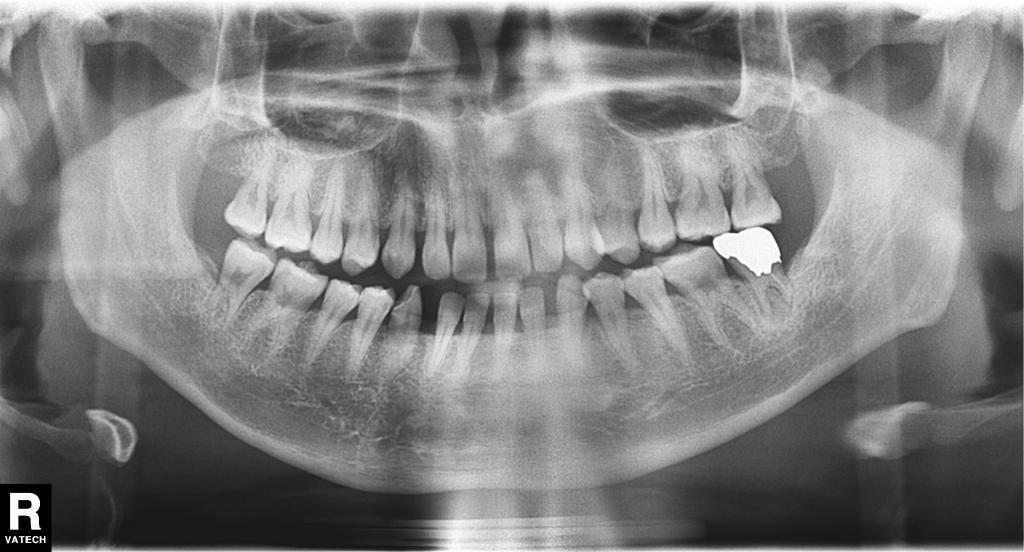 根管治療前　34_2
