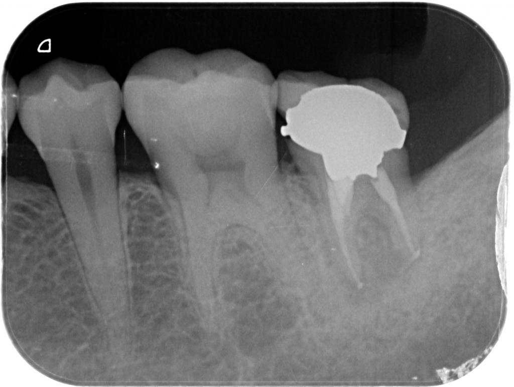 根管治療後　34_6
