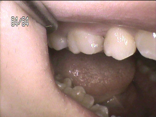 虫歯治療後　1_6