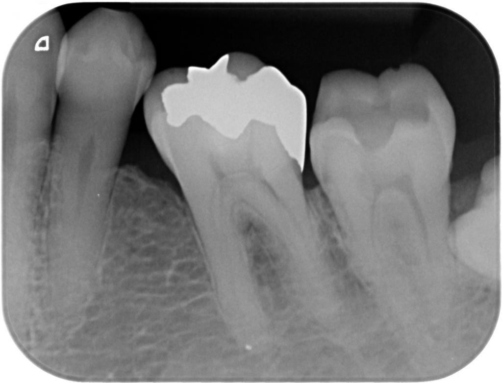 虫歯治療前　10_2