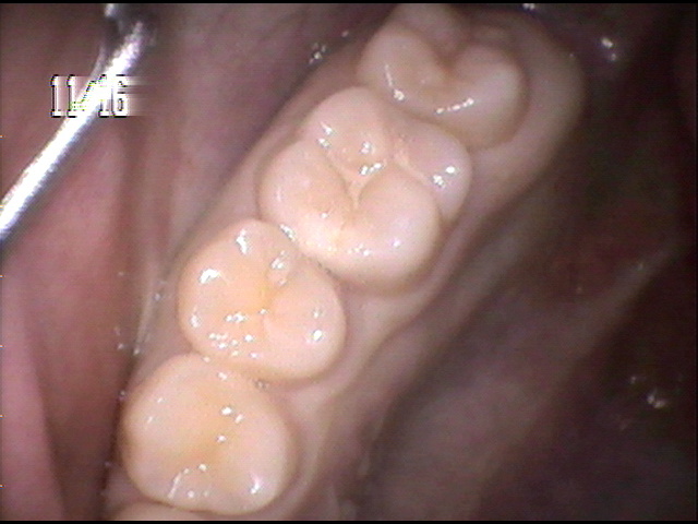 虫歯治療前　11_1
