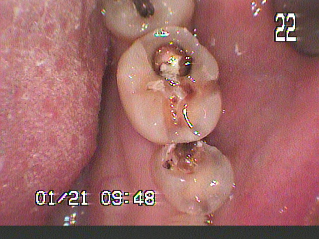 虫歯治療前　12_2