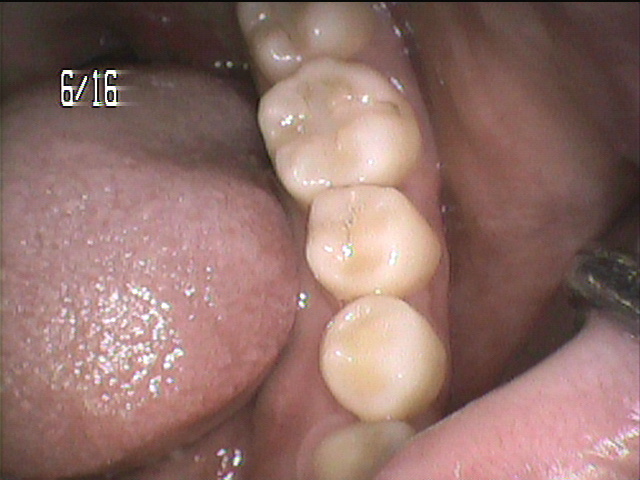 虫歯治療前　15_1