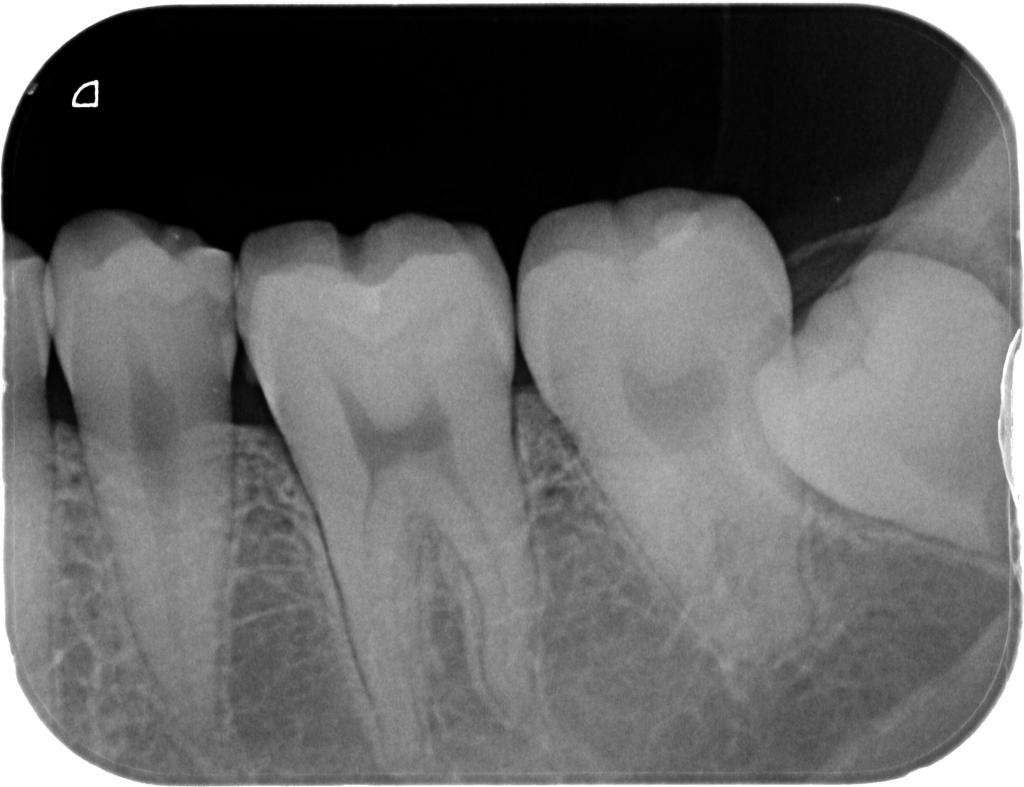 虫歯治療前　15_2