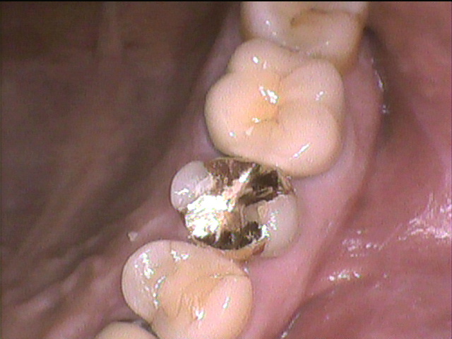 虫歯治療後　2_5