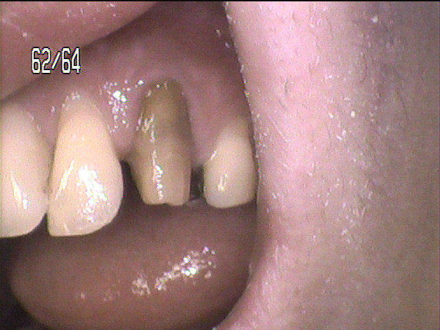 虫歯治療後　21_5
