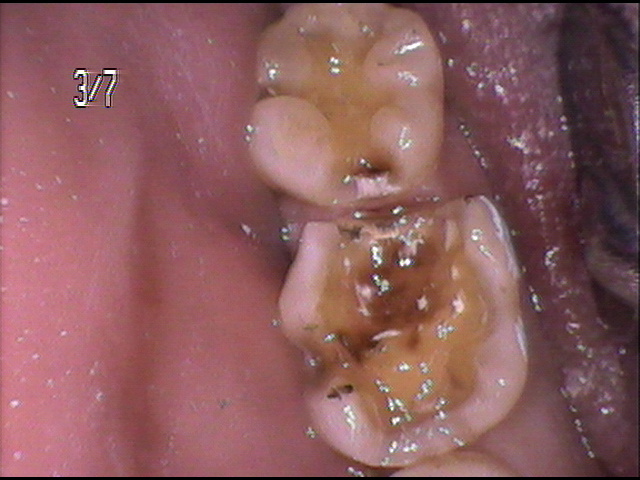 虫歯治療前　24_2