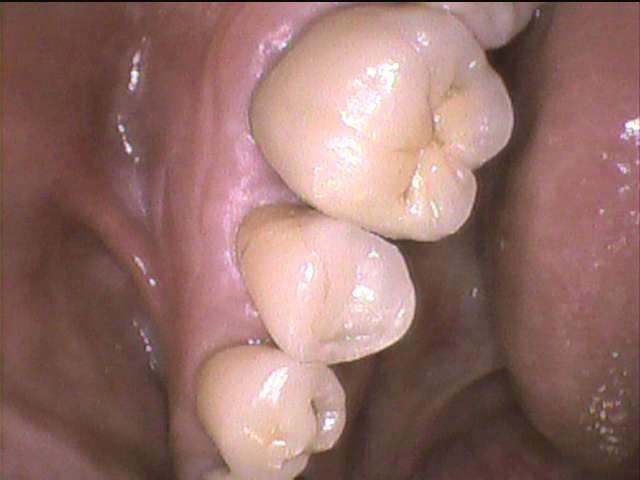 虫歯治療後　3_5