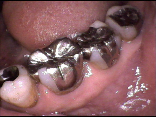 虫歯治療前　30_1