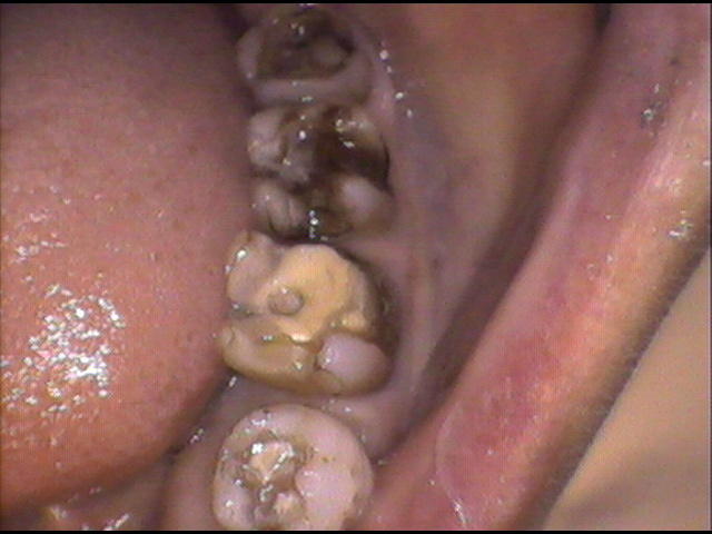 虫歯治療前　30_2