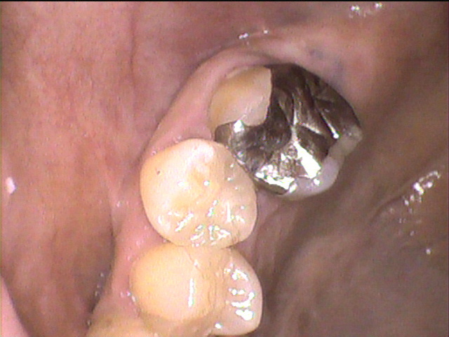 虫歯治療前　31_2