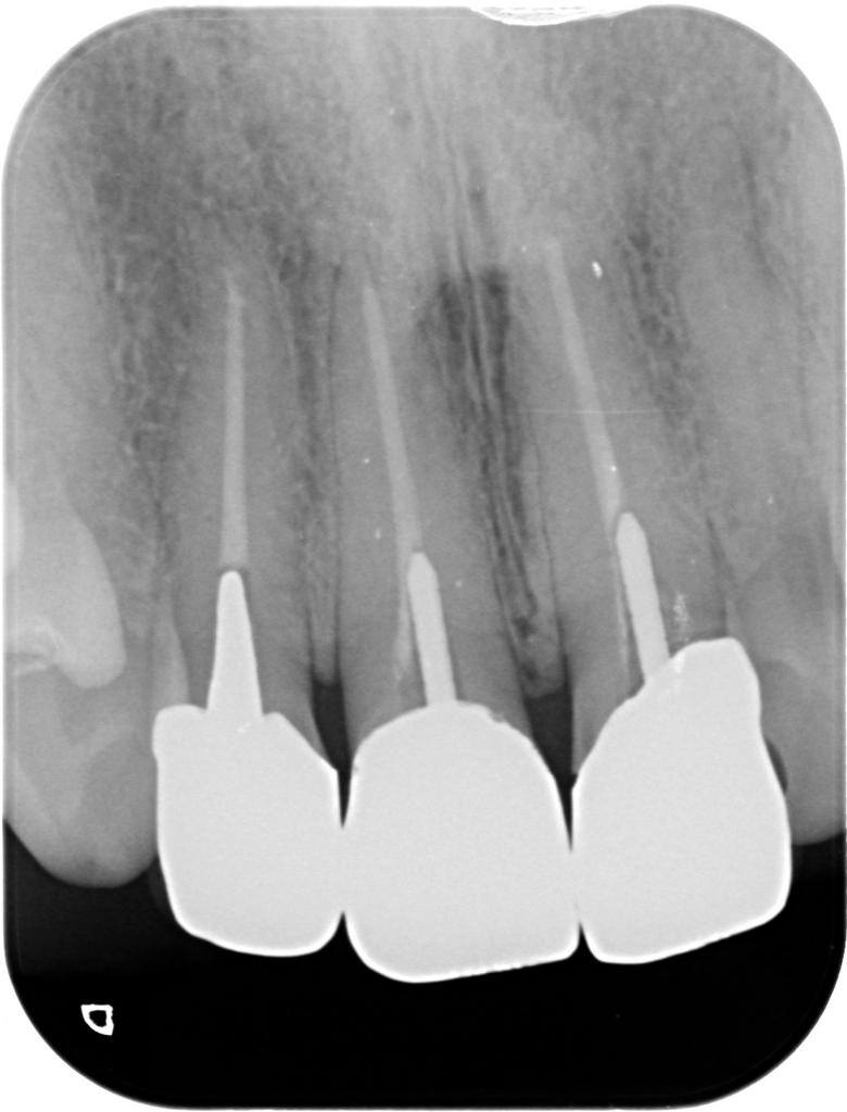 虫歯治療前　32_2