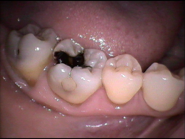 虫歯治療前　33_1