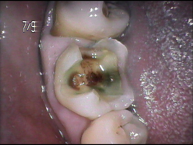 虫歯治療前　33_2