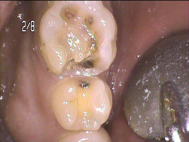 虫歯治療前　34_2