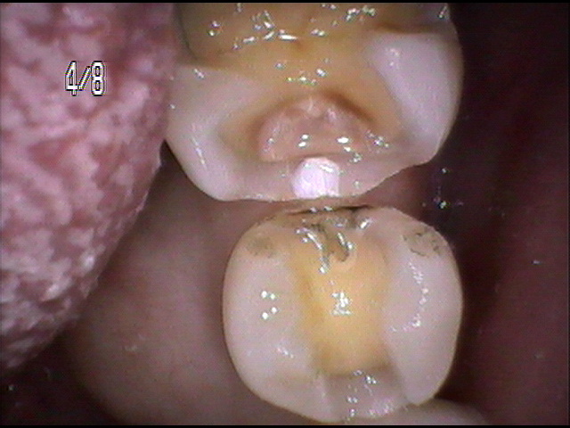虫歯治療前　35_2