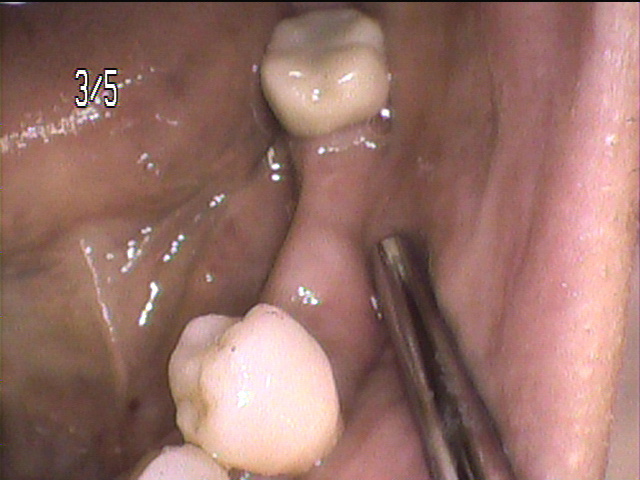 虫歯治療前　36_1