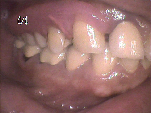 虫歯治療後　37_5