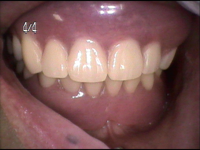 虫歯治療後　39_5