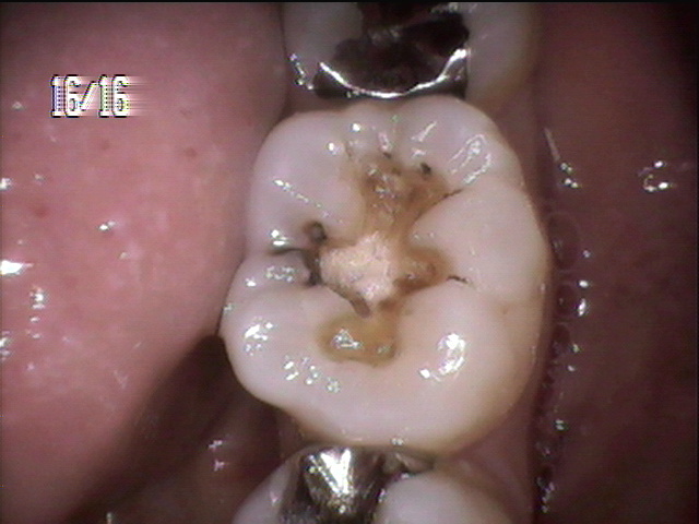 虫歯治療前　4_1